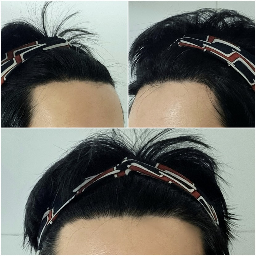 3주차  M자 고민되는 탈모 부위 
