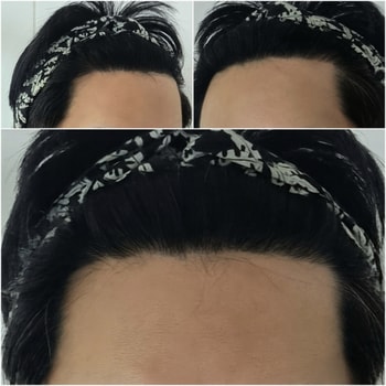 2주차 M자 고민되는 탈모부위 