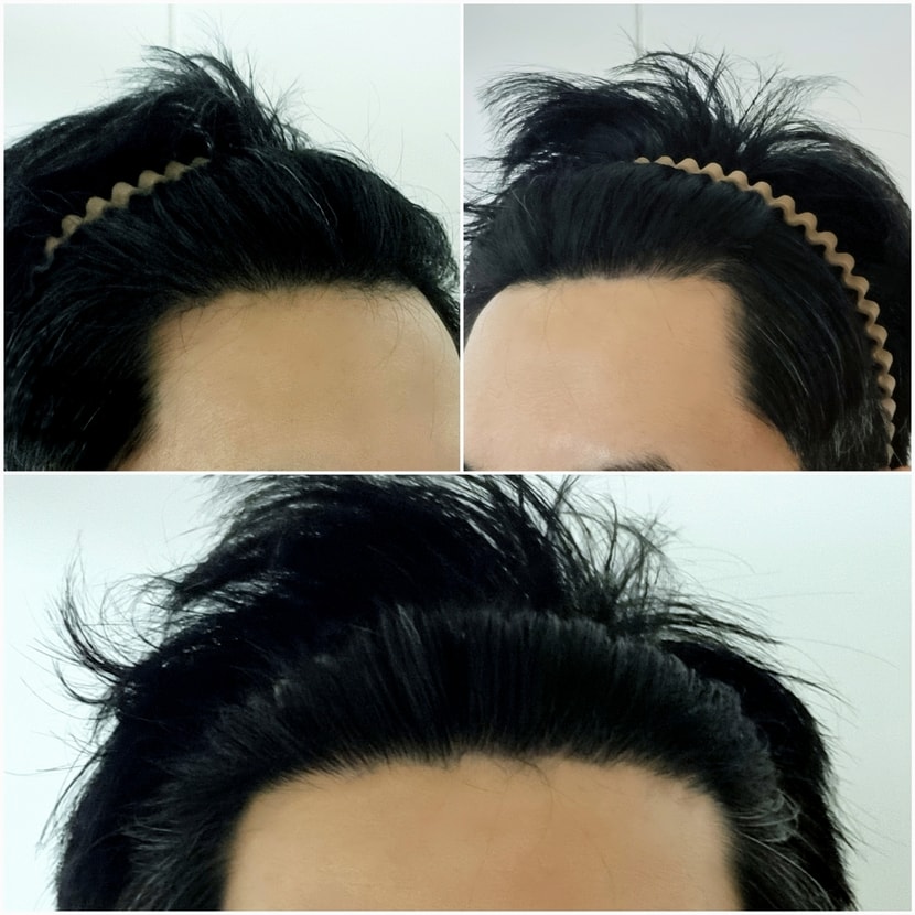 8주차 M자 고민되는 탈모부위