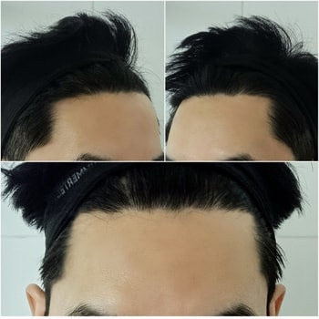 9주차 M자 고민되는 탈모부위 