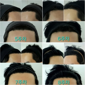 M자 고민되는 탈모부위(5주차~8주차)