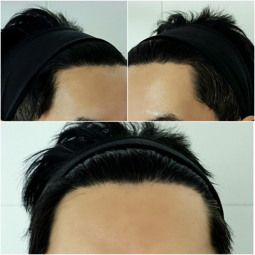 7주차 M자 고민되는 탈모부위 