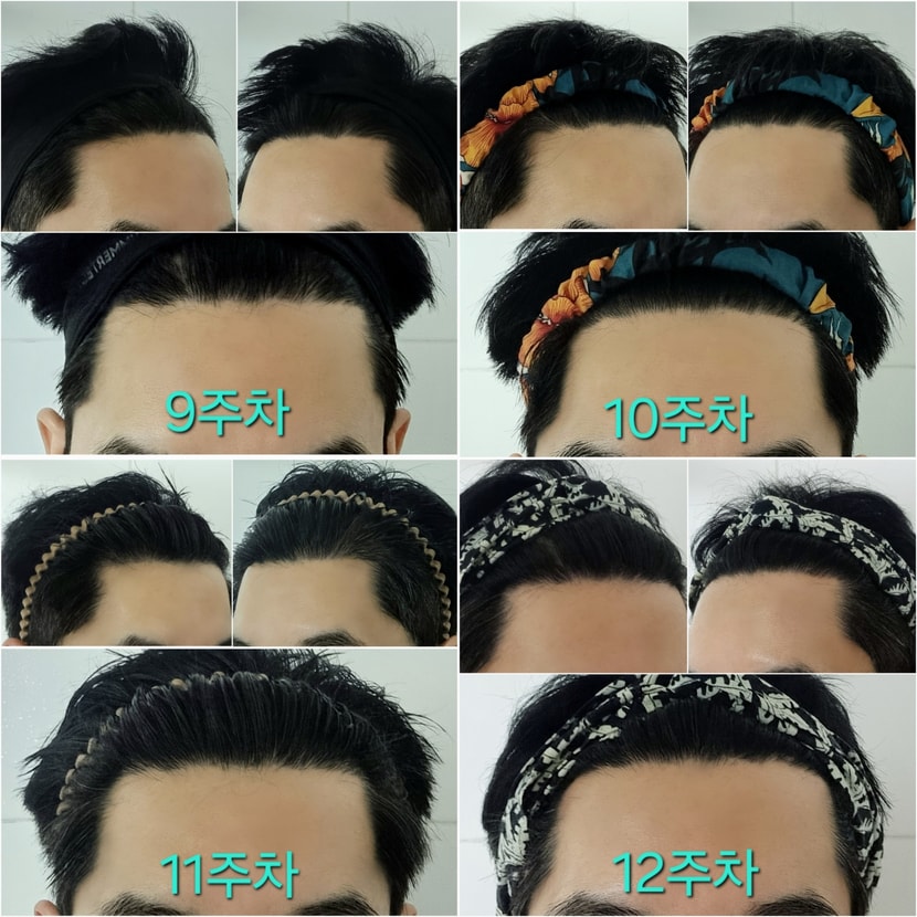M자 고민되는 탈모부위(9주차~12주차)