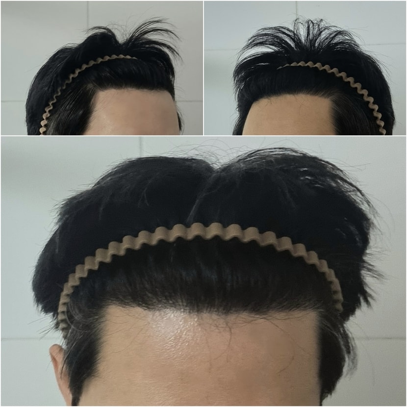 1주차 M자 고민되는 탈모부위