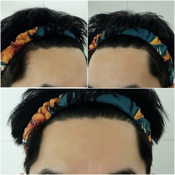 10주차 M자 고민되는 탈모부위 