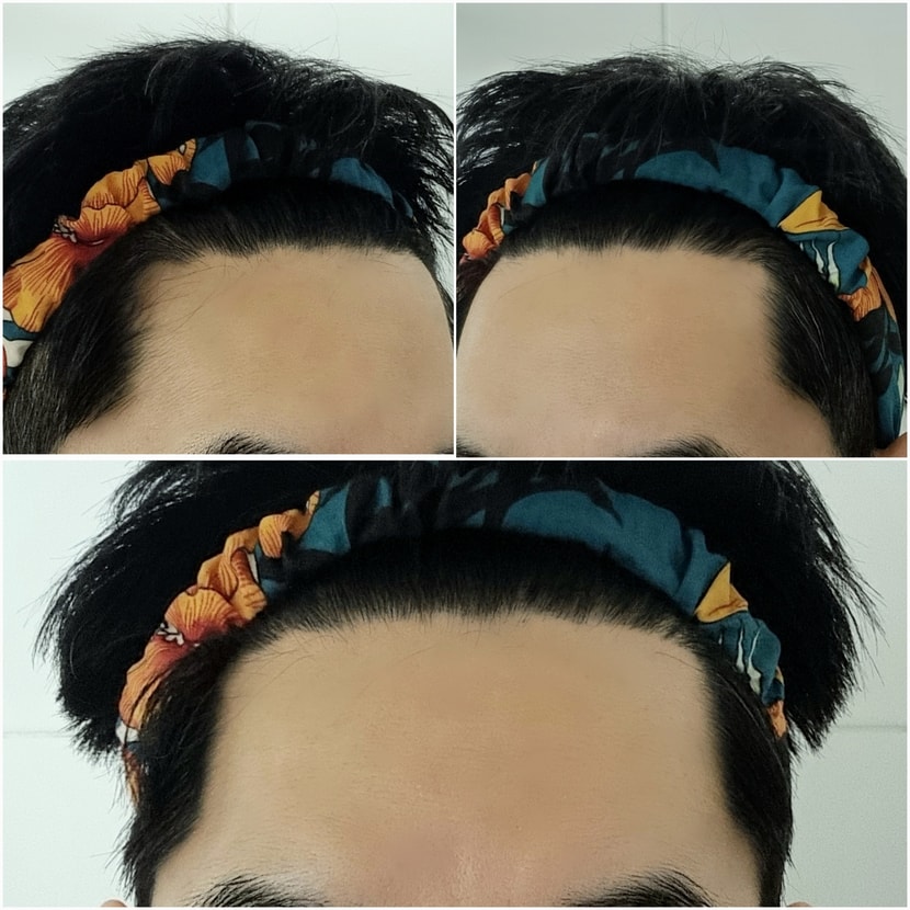 10주차 M자 고민되는 탈모부위 