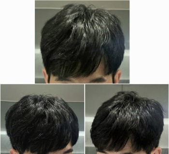 현재 모발 상태