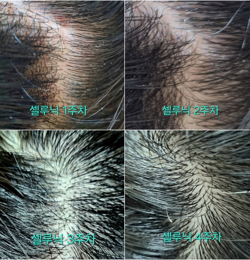 두피 주차별 사진비교 
