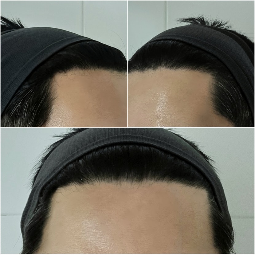 5주차 M자 고민되는 탈모부위