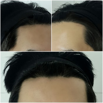 6주차 M자 고민되는 탈모부위 