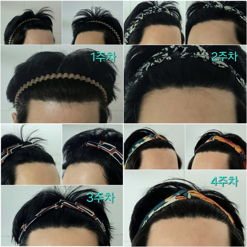 주차별 고민되는 M자 탈모부위