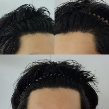 헤어라인