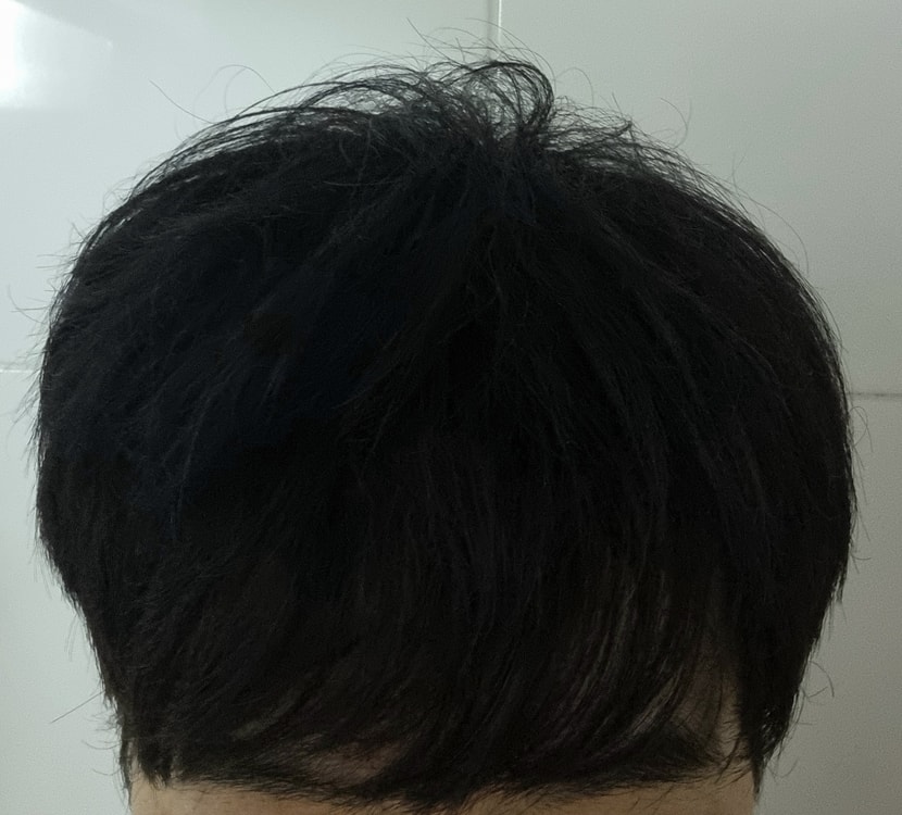 현재 모발상태