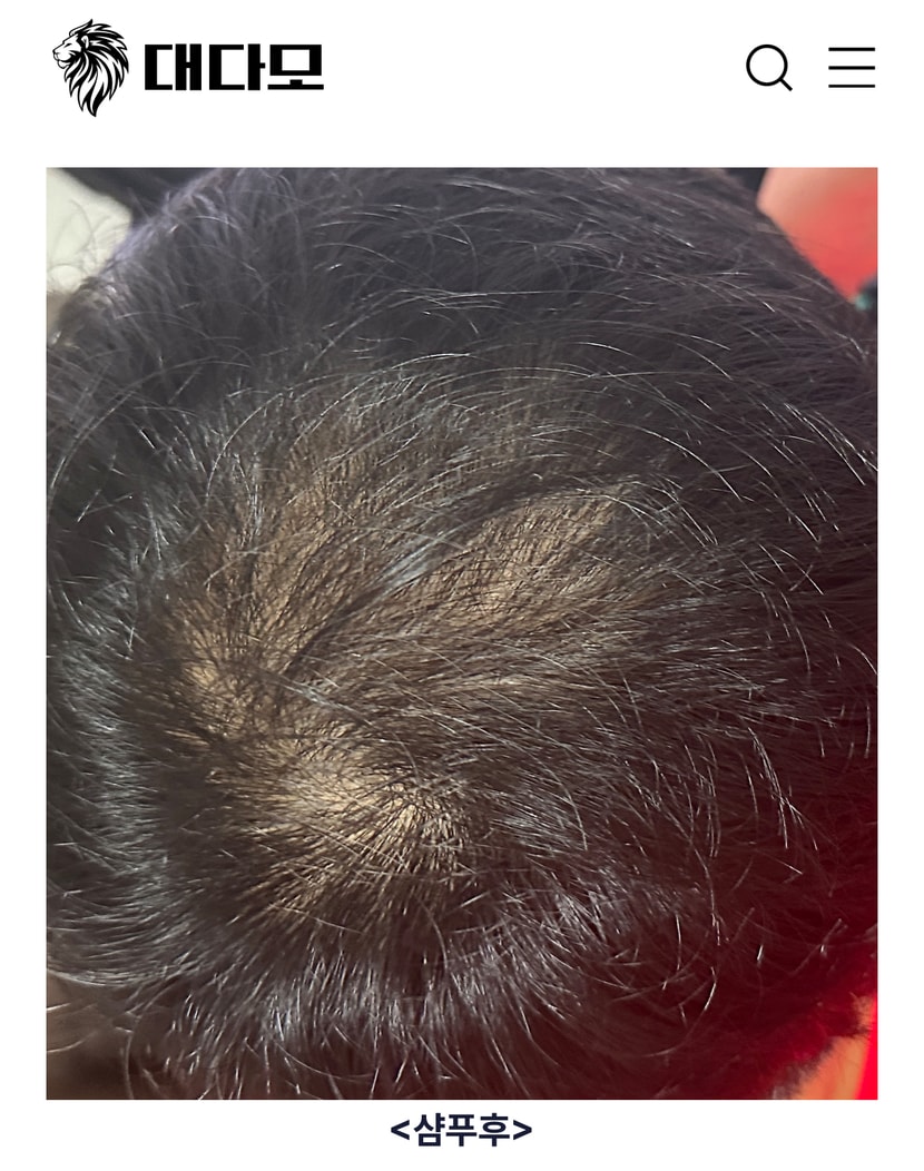 28일전 샴푸전 사진
