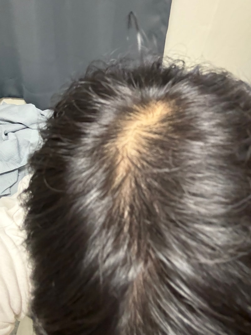 스카비올 샴푸 4주차 후기