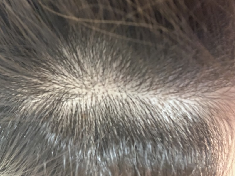 黑森林根动力洗发水 4周后期