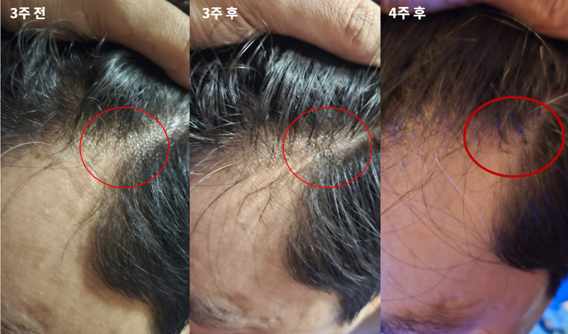 オンユビオチン4週目後期 - 薬箱をほとんど空けた4週目前後のM字