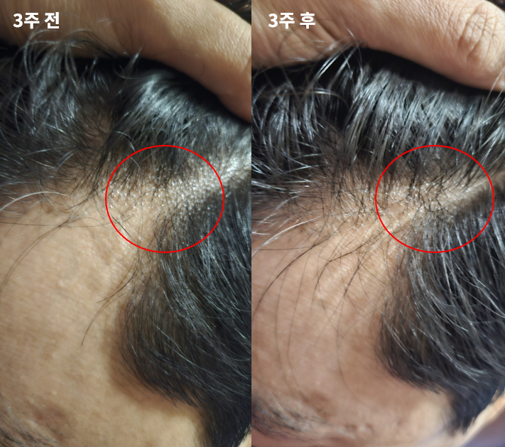 オンユビオチン3週目後期 - 3週目前後のM字