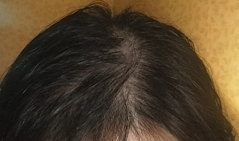 TS샴푸 1주차 후기입니다.