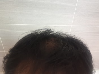 미라클세럼 바른 직후