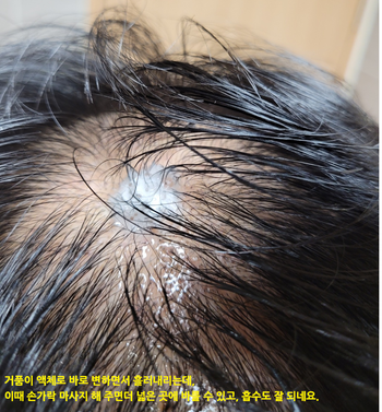 [사진4] 거품 형태의 두피영양제 도포 직후 (거품이 액체로 변신^^)