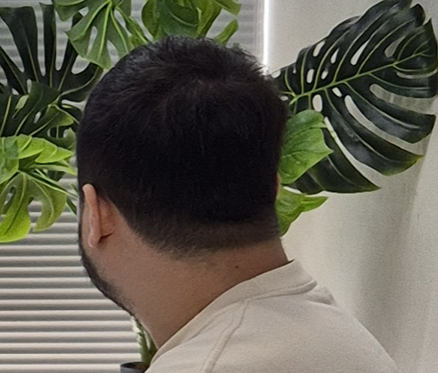 黑森林根动力洗发水 2周后期