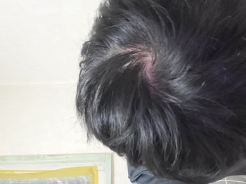 얼핏봐도 붉은기심한 두피