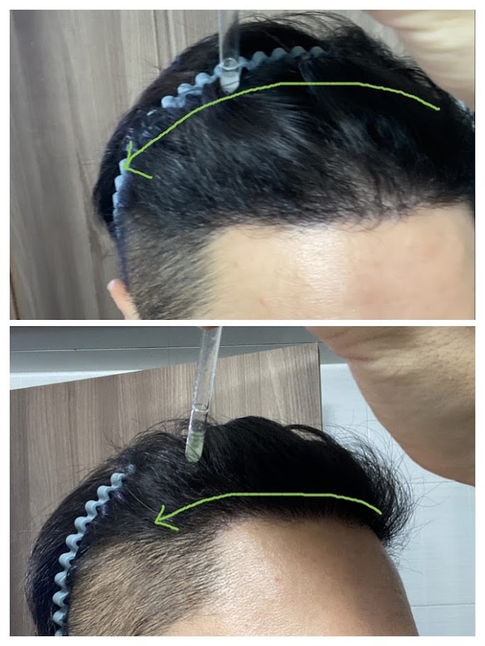 흔든 후 모발 이식부 및 정수리 부분에 총 2회 도포하고 마사지 하였습니다.
