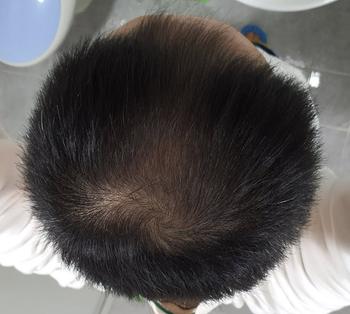 멍케샴푸 사용전