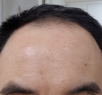 2주 사용 후 이마