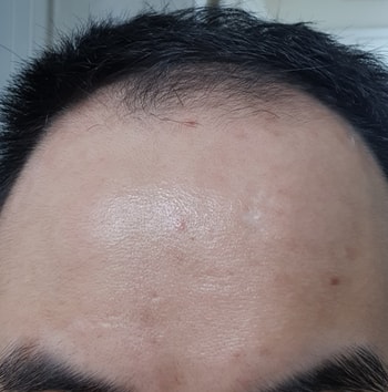 1주 사용 후 이마
