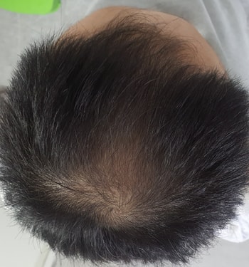 1주 사용 후 정수리