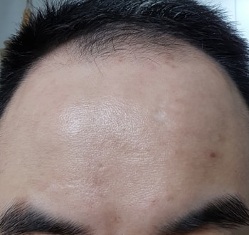 사용 전 이마