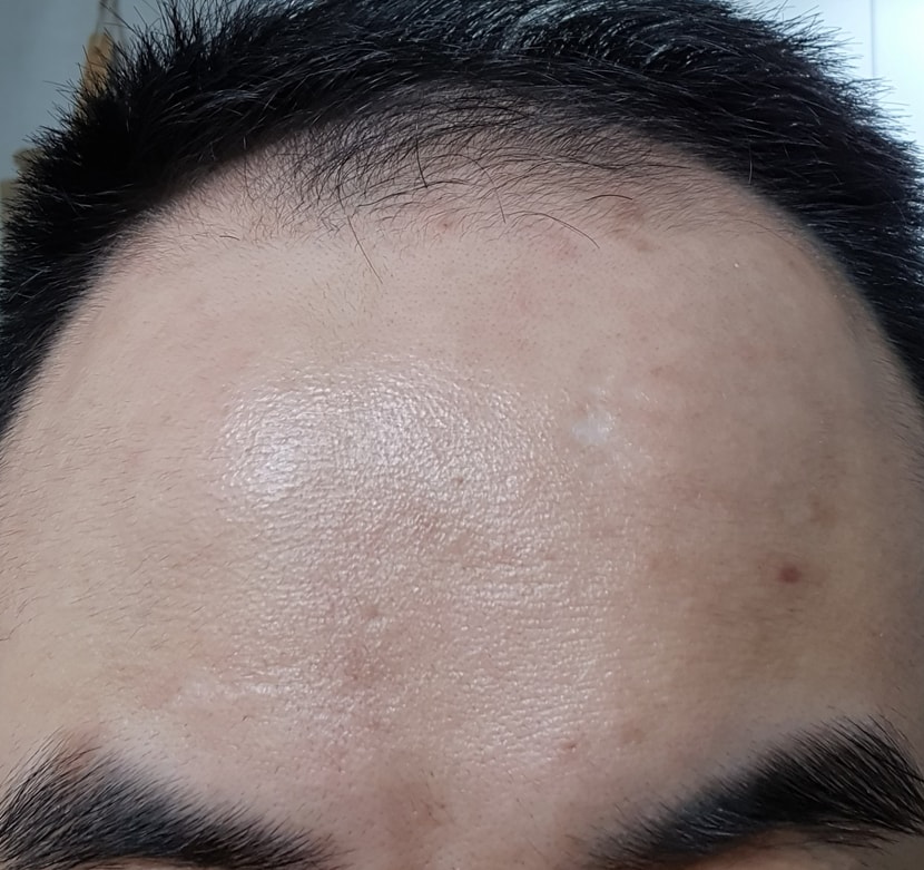 사용 전 이마