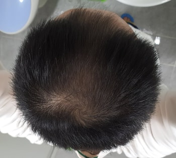 멍케샴푸 사용전