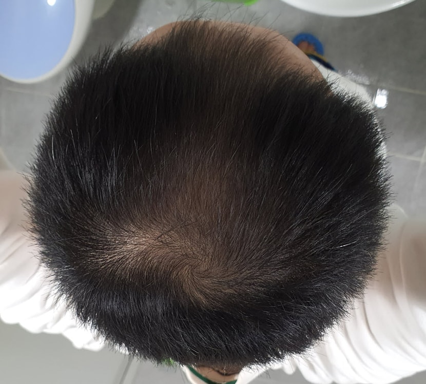 멍케샴푸 사용전