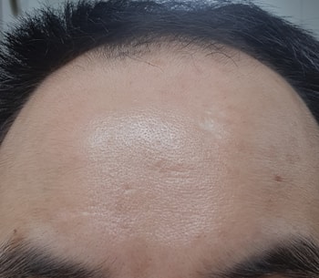 3주 사용 후 이마
