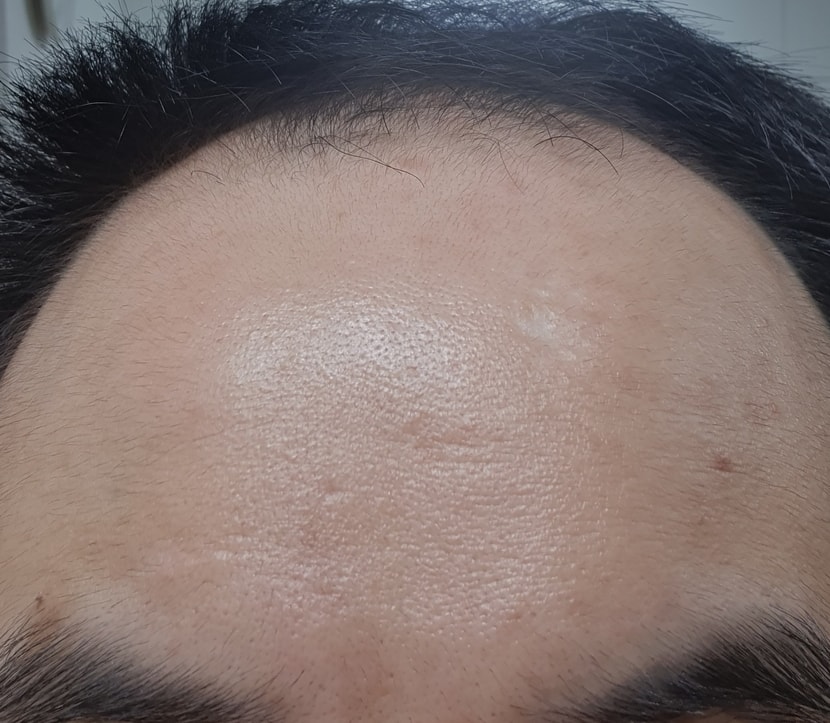 3주 사용 후 이마