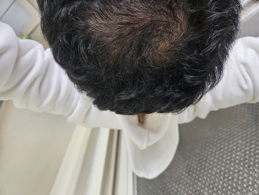 15일차 정수리모발이 굵어지는듯한 사진