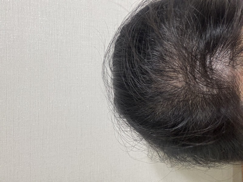 PGGM 탈모샴푸 3주차  후기