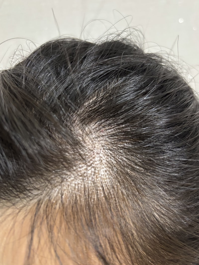 려 루트젠 탈모전문케어 두피 에센스 1주차