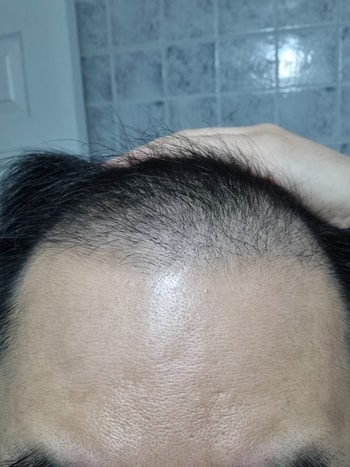 3월 16일 아위스칼프 사용전(정면)