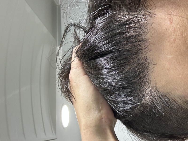 4th week review of hair implanter