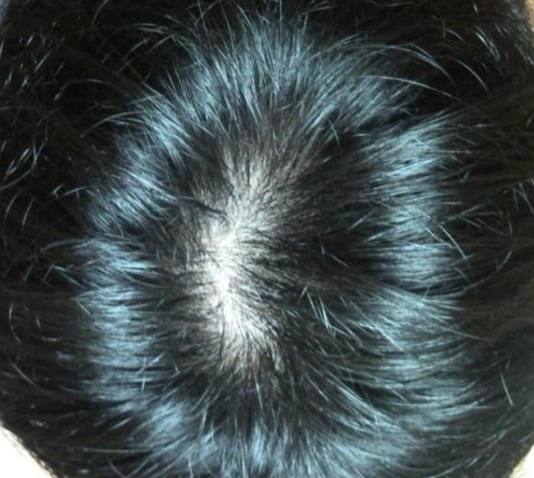 닥터포헤어 폴리젠 2주차 실사용 리뷰