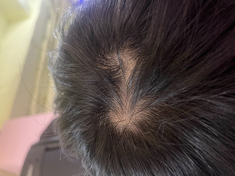 オンユビオチン2週目の体験談