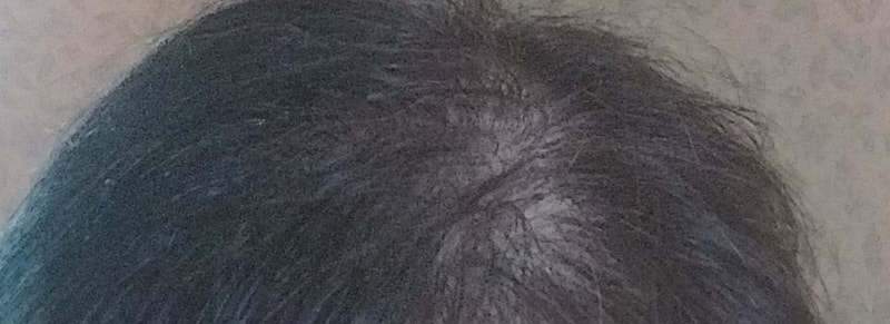 是ts洗发水第3周后期。