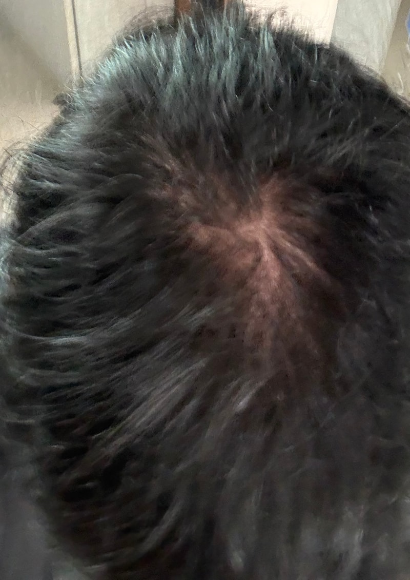 黑森林根动力洗发水 4周后期