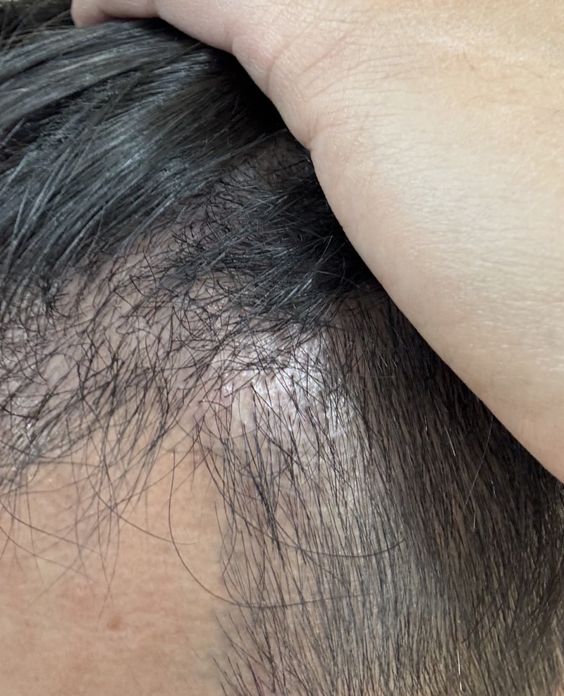 [ビエルモパッケージ6週目の体験談] 植毛部位の集中トナー使用