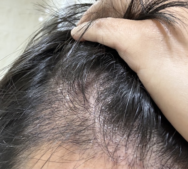 [パントモナ] 植毛ラー 1週間服用後の体験談