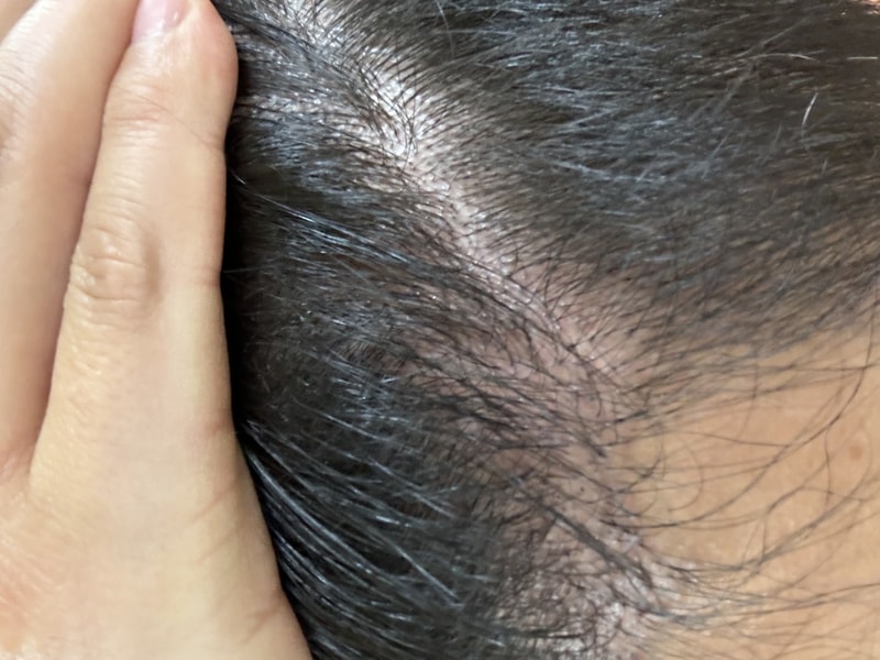 [3주차 후기] - 모발이식 부위 집중사용